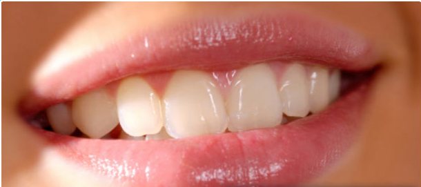 scaling and polishing